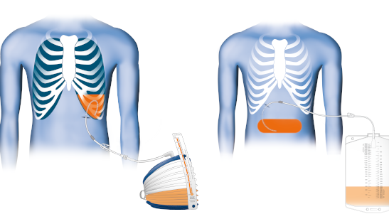 Ilustationen zwei Torsos Pleuraergusss mit Reservoir und Aszites mit Beuel