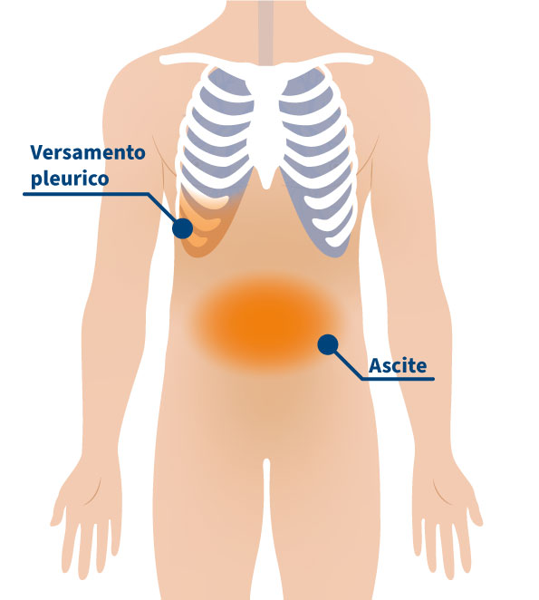 versamento pleurico (colloquialmente acqua sui polmoni) et L’ascite (liquido addominale)