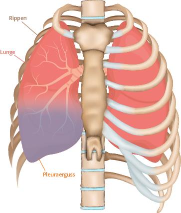 Pleuraerguss / Wasser in der Lunge